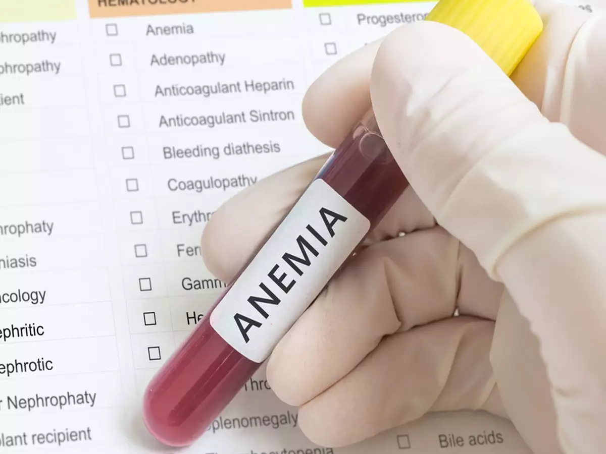 Eat these things to overcome the problem of anemia, the effect will be visible within a month