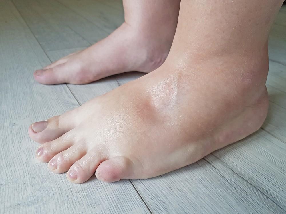 Swelling in feet? Is this the cause of any serious illness, know why this problem occurs