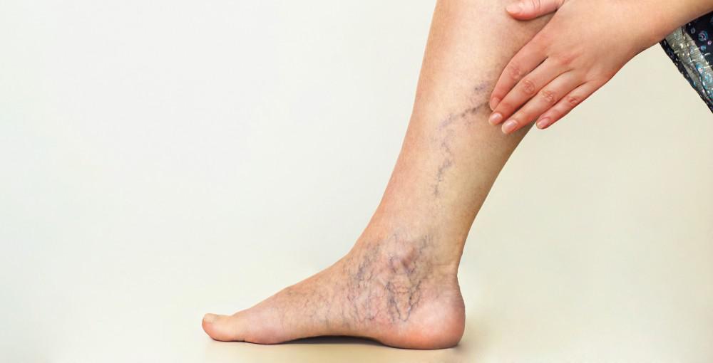 Beware of 5 signs, the problem of blocked veins at a young age? Know the cause and treatment